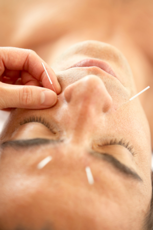 Facelift Acupuncture